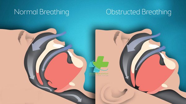 درمان های جراحی اختلالات انسداد تنفسی خواب (دکتر محمد علی اصغری)