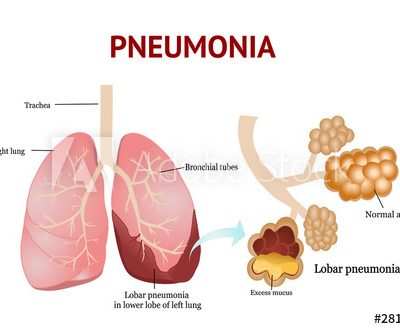 پنومونی | بیماری های عفونی ریه