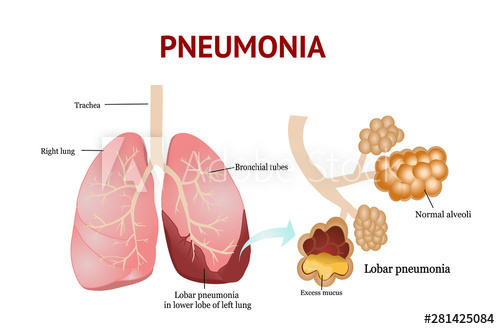 پنومونی | بیماری های عفونی ریه