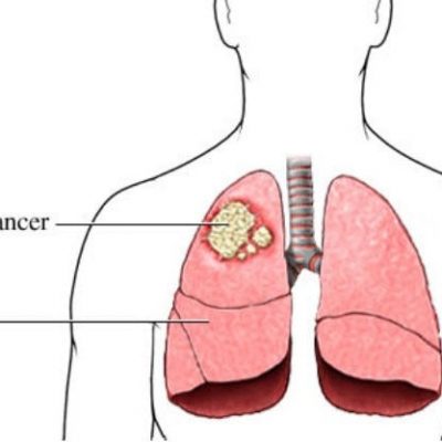 سرطان ریه یا بیماری های نئوپلاسمی ریه