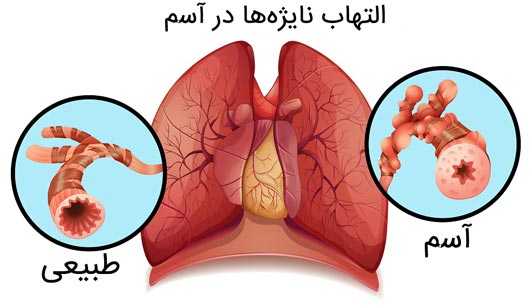 التهاب نایژه ها در آسم